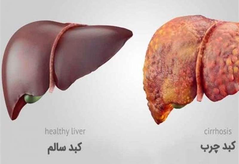 کبد چرب از علائم و درمان‌ های خانگی تا نسخه شفا بخش ابن‌سینا