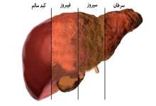 ۶ علامت چرب شدن کبد / یک نکته‌ طلایی برای پاکسازی کبد چرب؛ هرچه زودتر انجام دهید