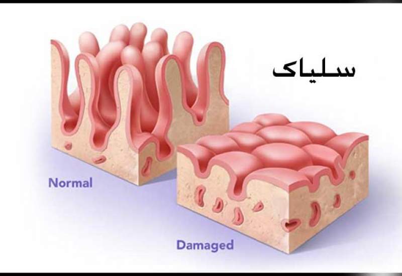 چند بیمار سلیاکی در کهگیلویه و بویراحمد شناسایی شد؟